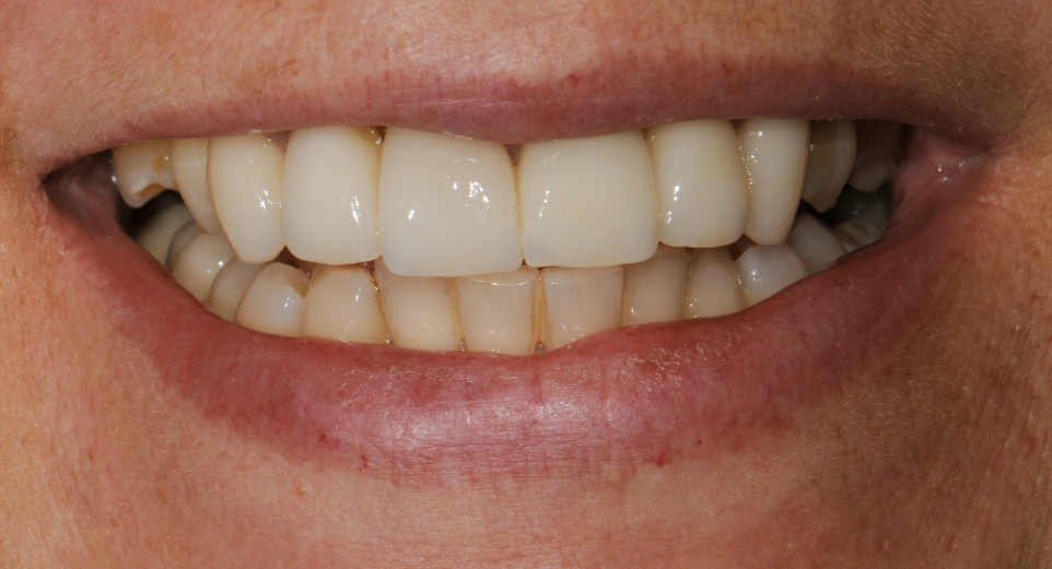 Before BarZero Zirconia Installation